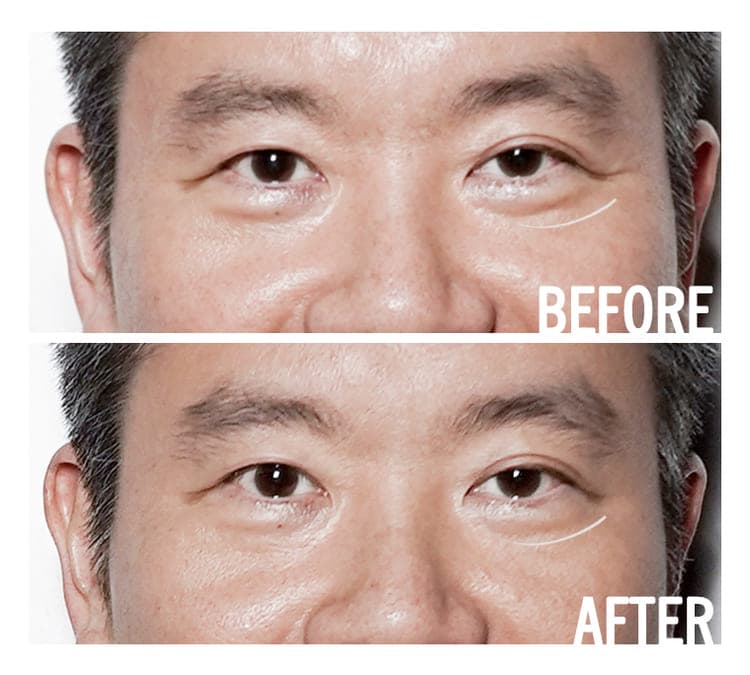 Access Facelift ®